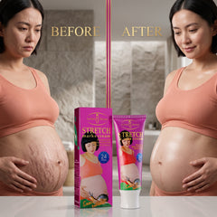 AICHUN BEAUTY Stretch Marks Cream Snail Extract